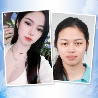 Cắt Mí