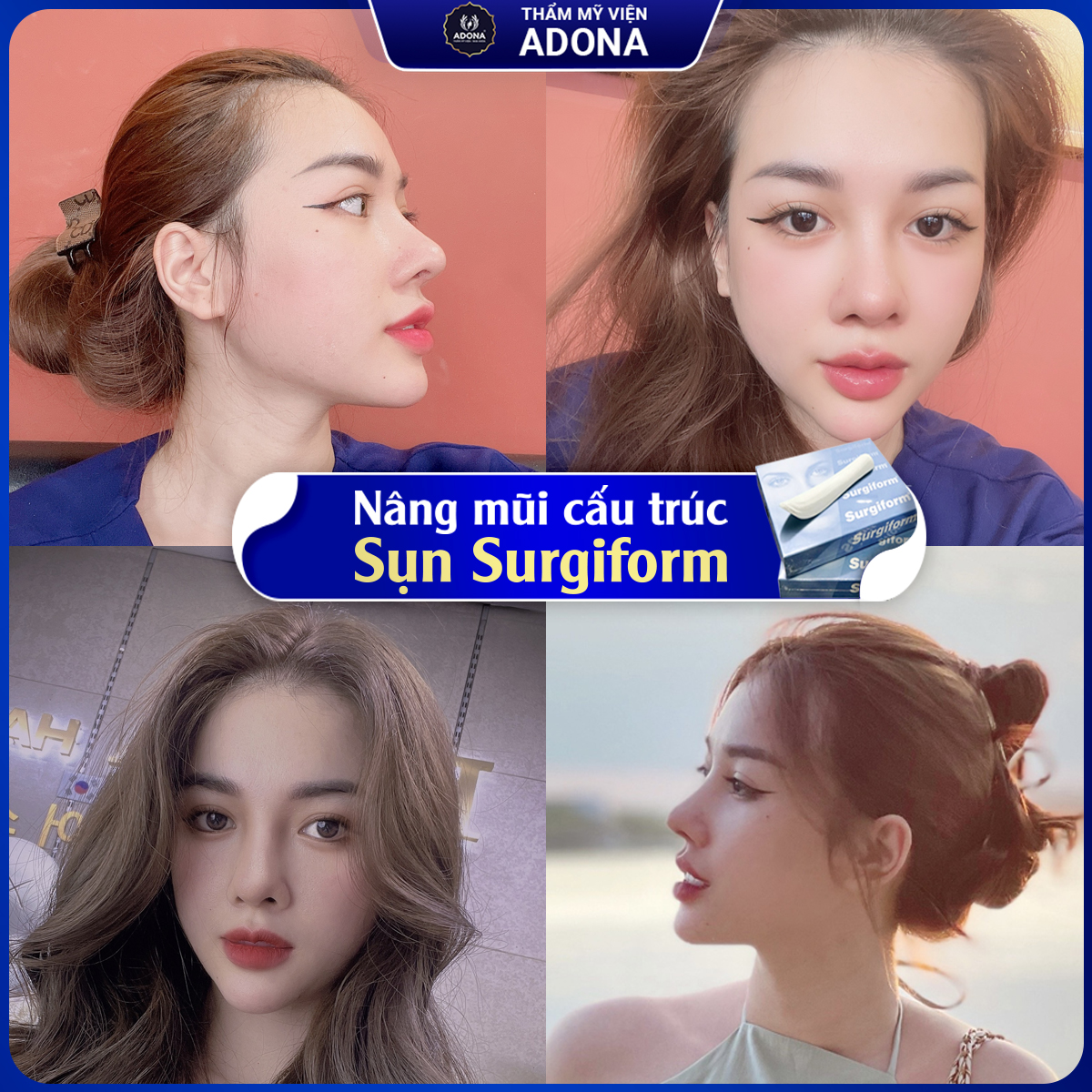 Nâng mũi cấu trúc là gì? Tại sao 80% chọn nâng mũi cấu trúc
