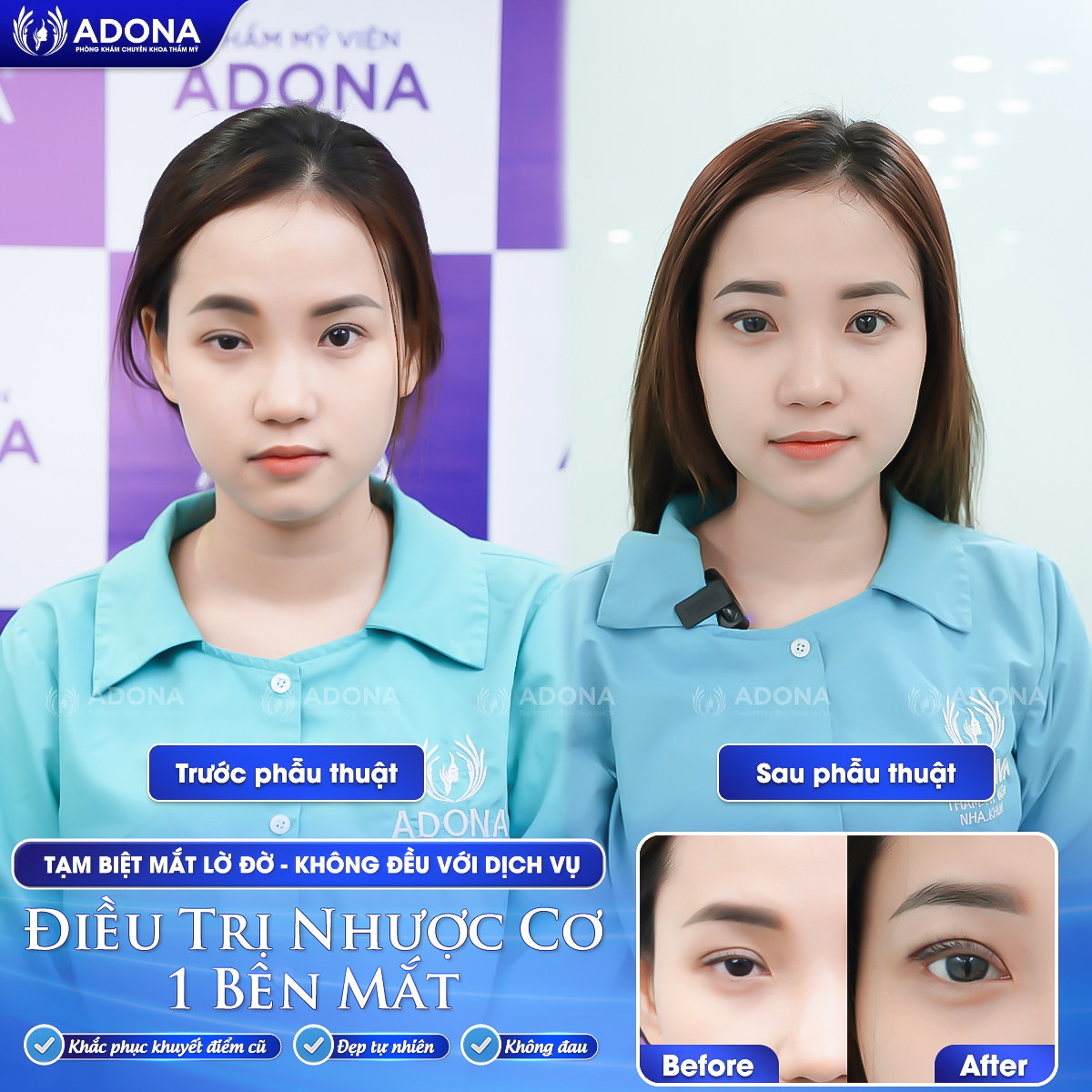 Nhược cơ nâng mi: Nỗi ám ảnh của giới trẻ